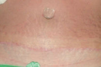 Liposuction and Abdominoplasty Scar after 2 months