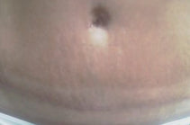Liposuction and Abdominoplasty Scar after 4 months