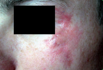 Burn scar before treatment