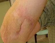 Trauma scar after 3 month treatment