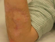 Trauma scar after 6 month treatment