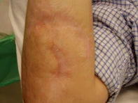 Trauma scar after 7 month treatment