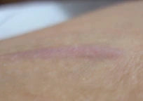 Incision Scar after 2 Months treatment