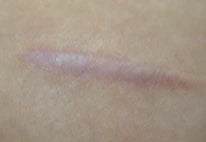 Incision Scar after 5 Months treatment