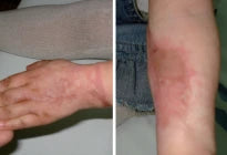 Both scars after 15 days’ treatment