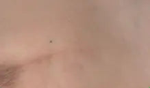 Post-Carcinoma Surgery Scar after 15 days