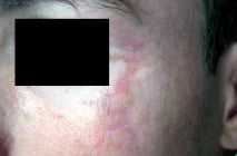 Burn scar after 21 weeks