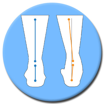 Insoles for supination example of supination