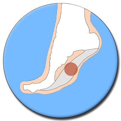 example photo of where plantar fasciitis hurts on the foot