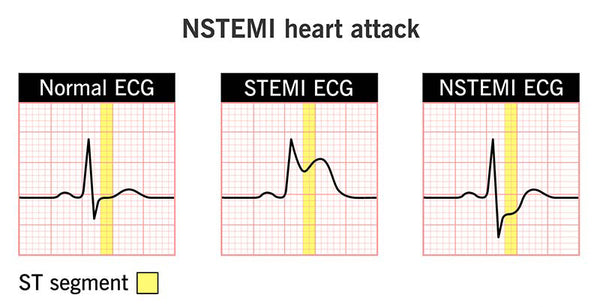 normal ecg vs heart attack ecg