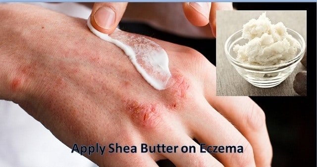 Shea Butter for eczema