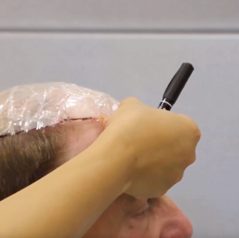 Hair replacement template on man's head