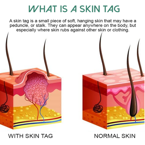 OrganicPro SkinTag FastRemover Patches 