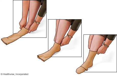 etape 3 enfilage chaussettes de compression contention