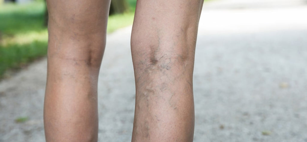 varices jambes douloureuses