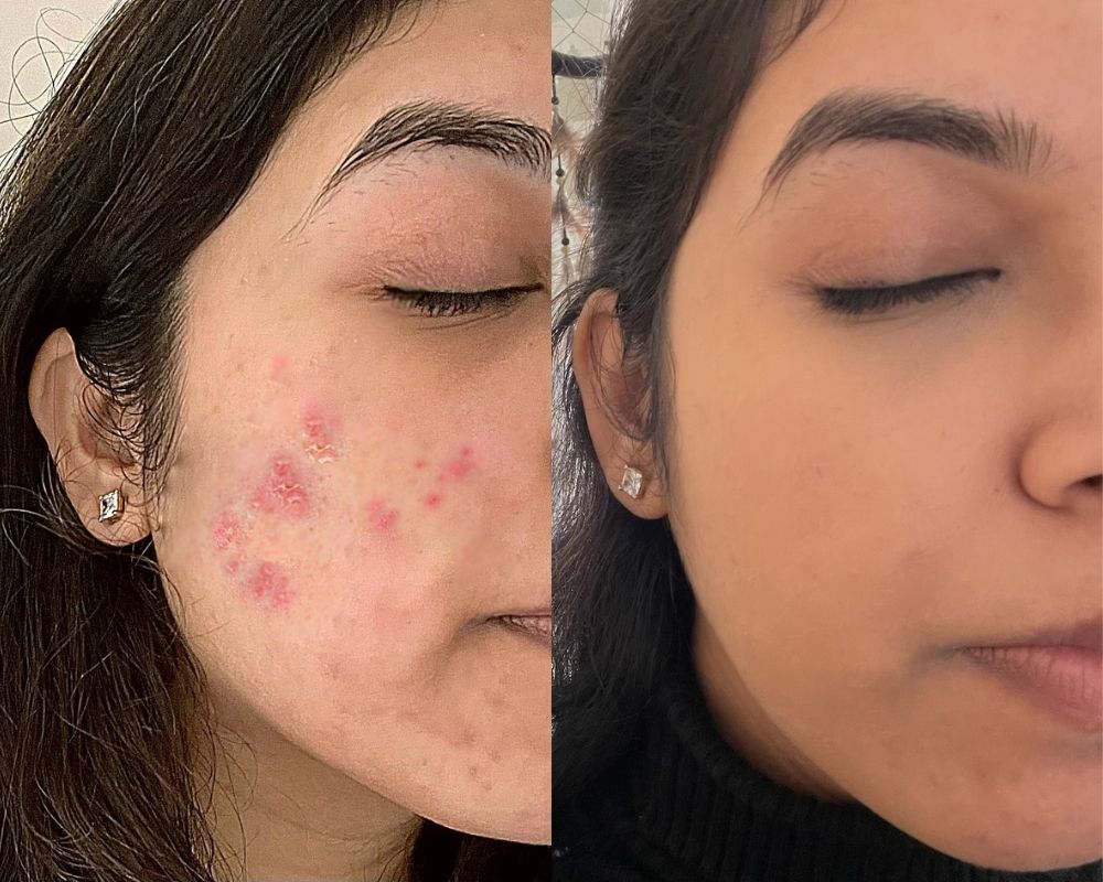 kanakam face care combo before after