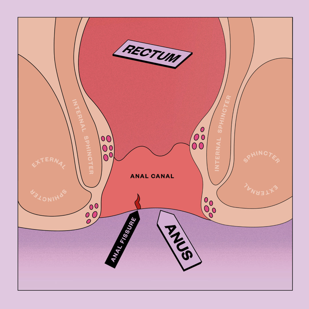 Anal Fissure diagram