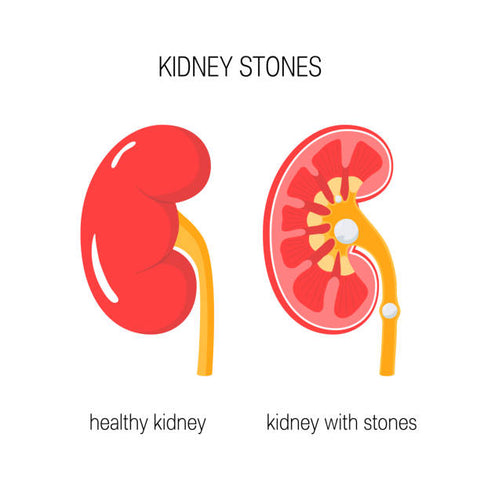 kidney stones