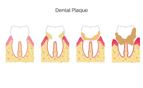 Stages of dental plaque
