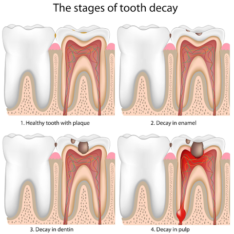 image showing how a cavity grows and spreads within a tooth