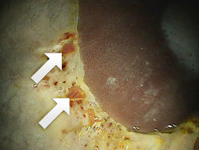 Close up of Gastric ulcers in a horse's stomach