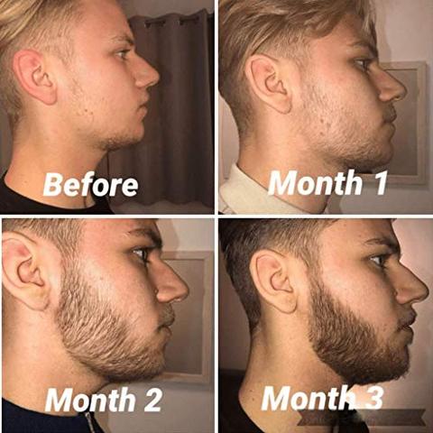 Beard Growth Kit - Derma Roller for Beard Growth, Beard Growth Serum Oil, Beard