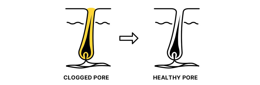 clogged pore vs healthy pore