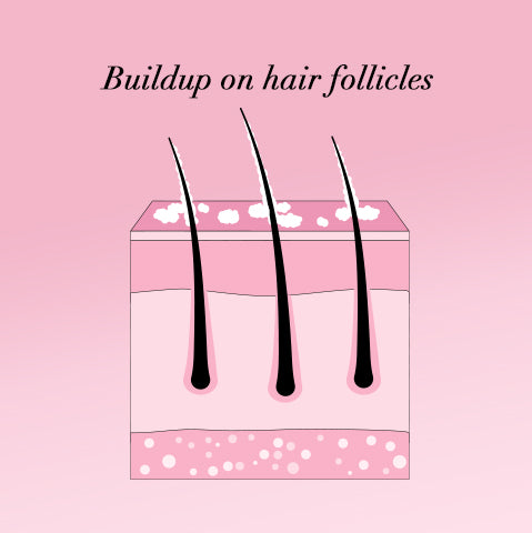 buildup on hair follicles