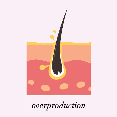 overproduction of sebum