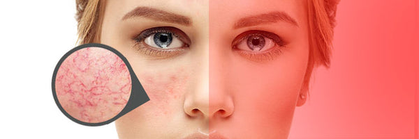 Treating Rosacea with Red Light Therapy