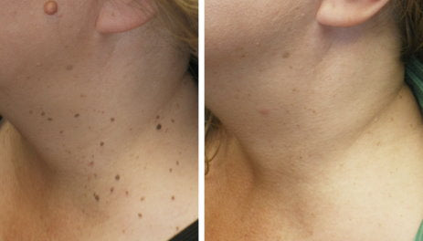 mole-removalbeforeafter6.jpg__PID:b58a15b3-84d5-4d89-90a3-2ad32ff5e151