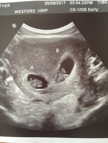 twins ultrasound pregnancy