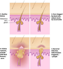 folliculitis