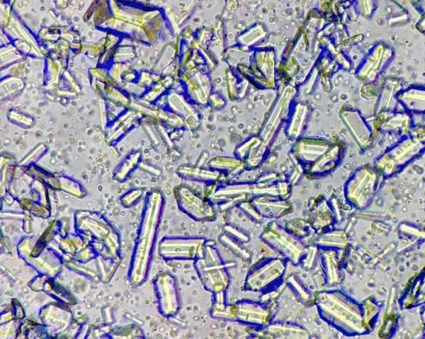 Microscopic image of struvite crystals in urine sample