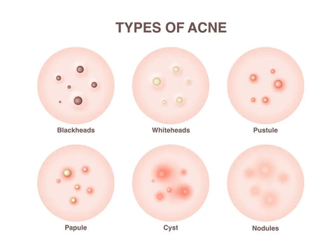 Different types of acne and how to treat them?