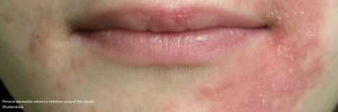 Perioral dermatitis refers to irritation around the mouth.