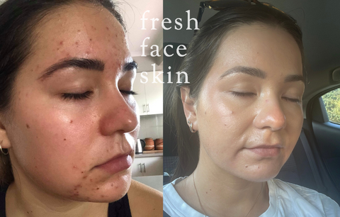 Nicolette's Journey with Hormonal breakouts & post inflammatory pigment