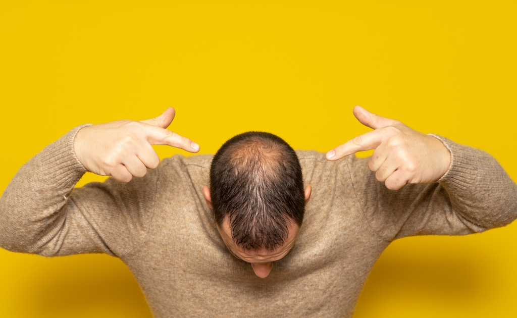 losing hair symptoms, balding frontal, signs of thinning hair