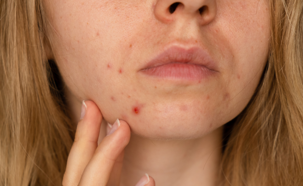 Acne scars treatment