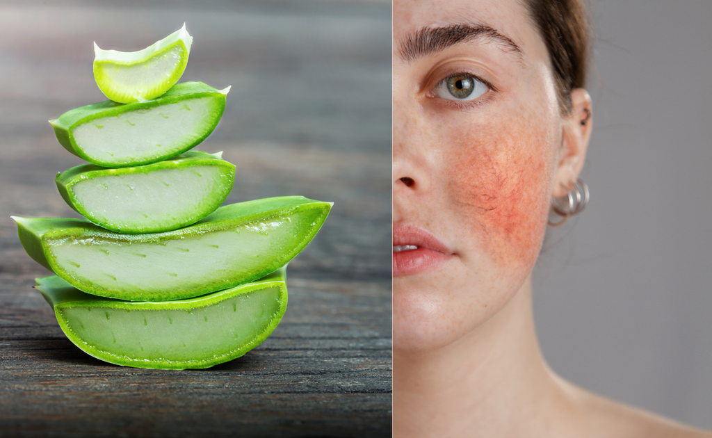 Aloe vera helps calming Rosacea Symptoms