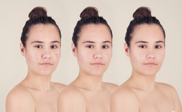 acne skin woman 
