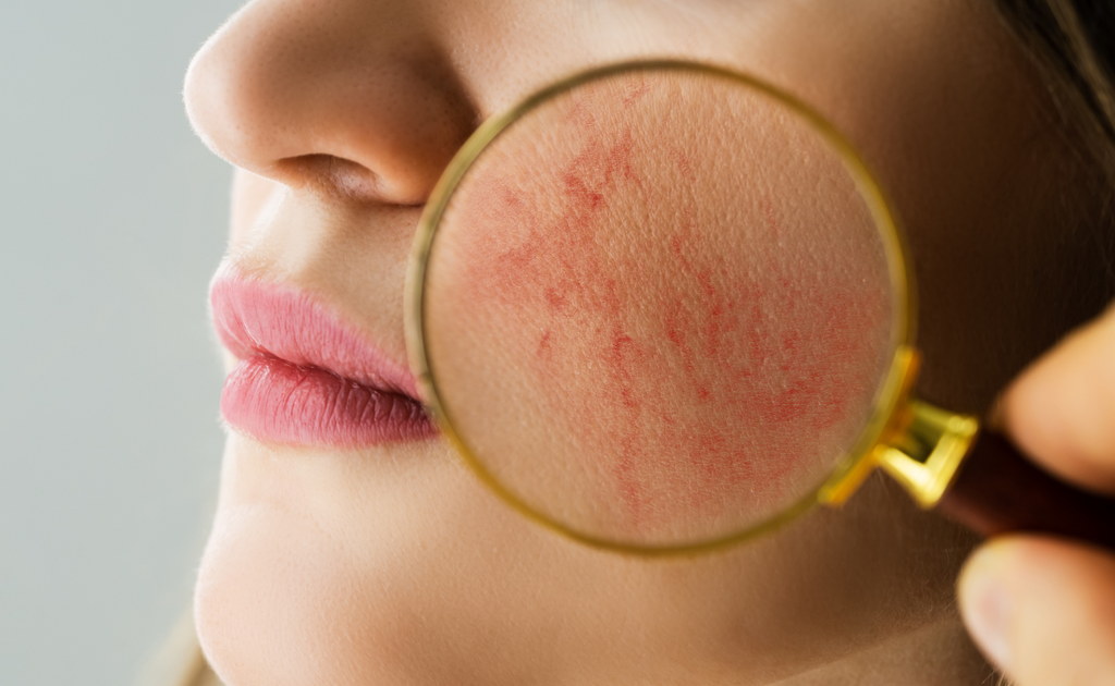 Understanding Rosacea,  Rosacea Symptoms