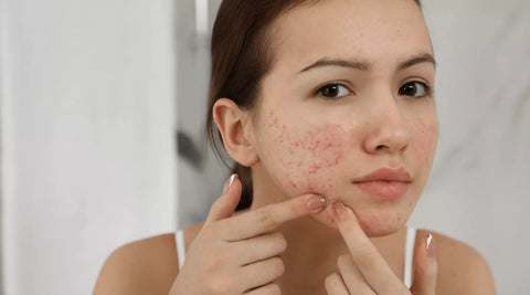 Understanding hormonal acne