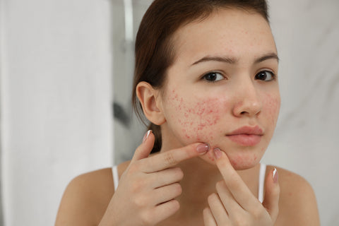 acne cream for sensitive skin
