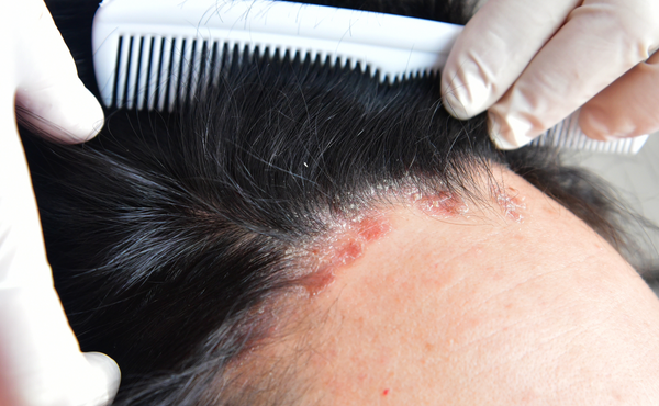 Doctor inspecting a case of scalp psoriasis