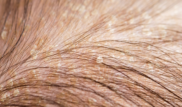 Close up image of irritated scalp