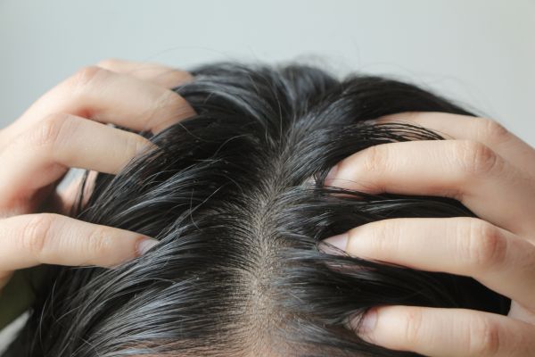 oily-scalp