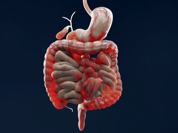 Inflammatory Bowel Disease