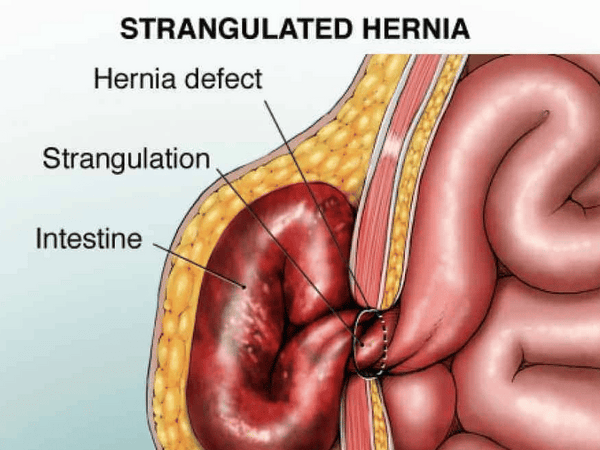 Strangulated Hernia