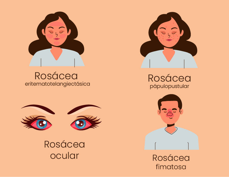 Tipos de rosácea y características de cada una. 